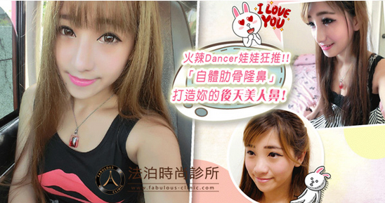 看娃娃做了自体肋软骨隆鼻+缩鼻翼，瞬间变得女神范儿了~