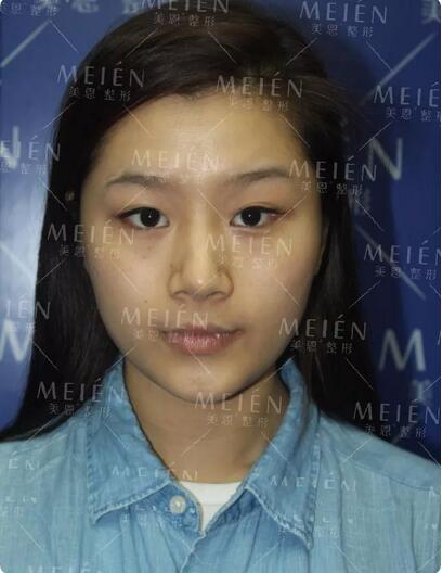 分段式假体隆鼻后30天撞脸张馨予？ 她的生活发生了什么变化？