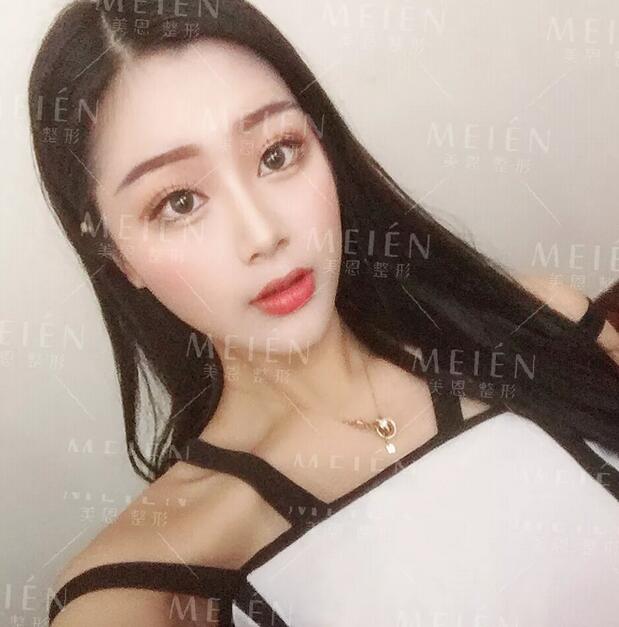 分段式假体隆鼻后30天撞脸张馨予？ 她的生活发生了什么变化？