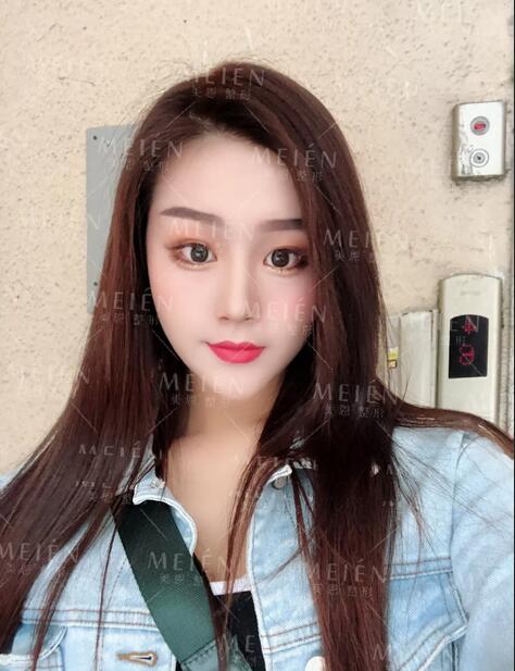 分段式假体隆鼻后30天撞脸张馨予？ 她的生活发生了什么变化？