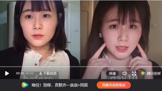 日本埋线提升功课：零恢复期从凹陷方脸变瓜子脸，只需要1.35万软妹币~