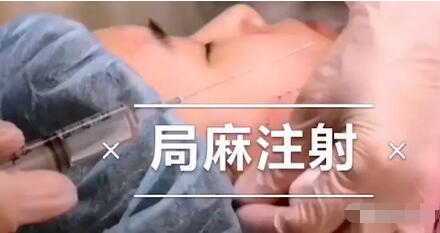 日本埋线提升功课：零恢复期从凹陷方脸变瓜子脸，只需要1.35万软妹币~