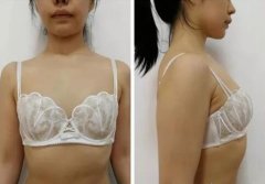 普罗菲耳profile医院假体隆胸术后真实感受，我的性感小“蜜”秘~ width=