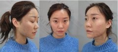 点阵激光祛痘坑6个疗程，我治好了顽固多年的痘痘！ width=
