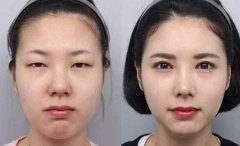 肿眼泡吸脂价格大概是多少? width=