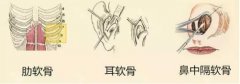 软骨隆鼻手术要多少钱? width=