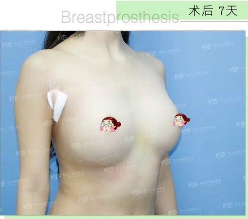 找厦门修志夫做了水滴型假体隆胸后，被赞“很有少女感”的美胸！