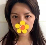 cfs芭比大眼术+纳米脂肪混血脸真实经历分享，请笑纳！ width=