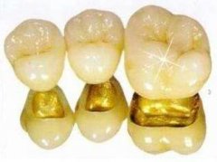 金钯烤瓷牙价格大概要多少呢? width=