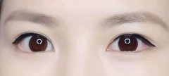 激光洗眼线伤眼睛吗? width=