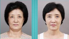 第三代塑美极有副作用吗? width=
