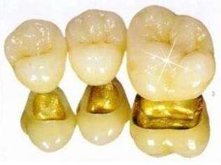 黄金烤瓷牙的使用寿命是多长?
