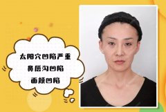 沈阳百嘉丽侯亚杰艾莉薇玻尿酸填充面部，一起来见证蜕变！ width=