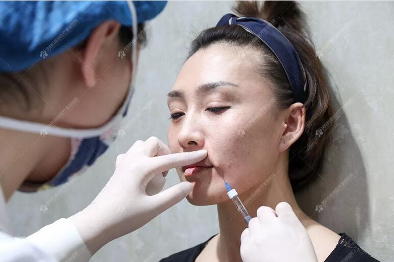 沈阳百嘉丽侯亚杰艾莉薇玻尿酸填充面部，一起来见证蜕变！