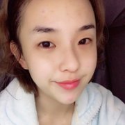 全切去皮去脂双眼皮恢复全过程分享，两个月后的我美美哒~~~ width=