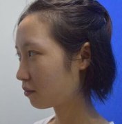 萍乡丽芙整形医院耳后软骨隆鼻+5S重睑术前后对比图分享 width=