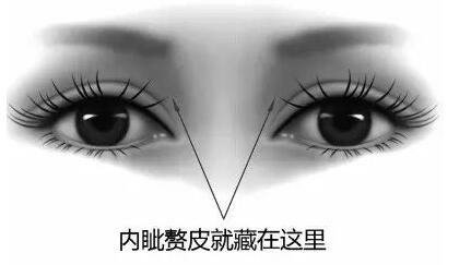 轻度内眦赘皮怎么矫正?