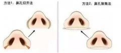 鼻孔不一样怎么矫正比较好? width=