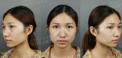 经历了下颌角接骨整形技术，她从土味girl到气质女神！ width=