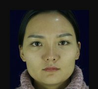 下颌角接骨整形技术136天亲身恢复体验果对比图 width=