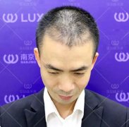 FUE-Ⅳ植发技术的真实案例有一条，我想冒昧分享给大家~ width=