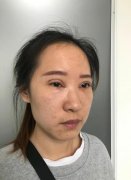 北京埋线双眼皮修复前后对比图：20天展现惊人变化 width=