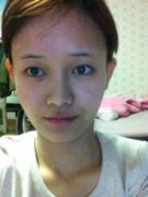 削骨手术前后对比图分享，看我是如何一步步变成小仙女的! width=
