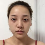 增大双眼皮64天前后对比图：小眼睛变大眼睛 width=