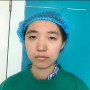 定点双眼皮15天恢复前后对比图：单眼皮的克星 width=