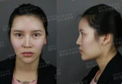 首尔丽格崔荣达下颌角截骨+颧骨内推案例分享，还不来收藏！ width=