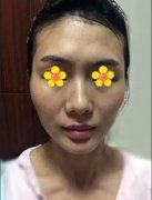 伊美尔吸脂填充面部去法令纹案例有一条，值得你看一看哦！ width=