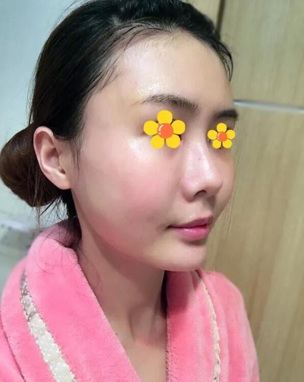 伊美尔吸脂