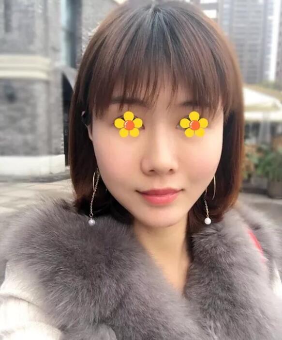 伊美尔吸脂