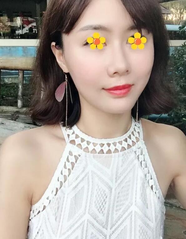 伊美尔吸脂