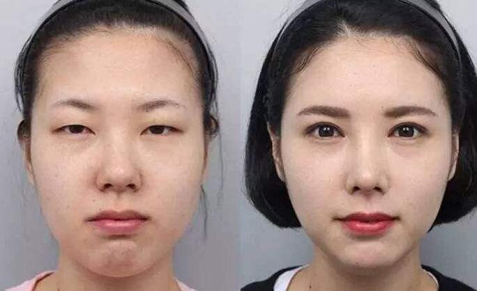 郑州美林整形医院双眼皮项目多少钱?贵吗?