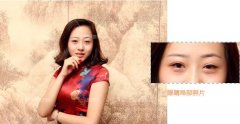 北京西美整形吕薇双眼皮案例昏享~ width=