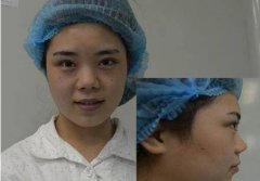 麻麻米亚隆鼻真实案例分享，内附恢复果图 width=