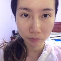 曹珂面部年轻化案例分享，三十天的惊变历程曝光~~
