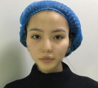 抽大腿脂肪填充到脸上，3个月恢复像我现在这样，不会看起来凶凶的~ width=