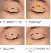 韩式三点双眼皮有哪些优势? width=