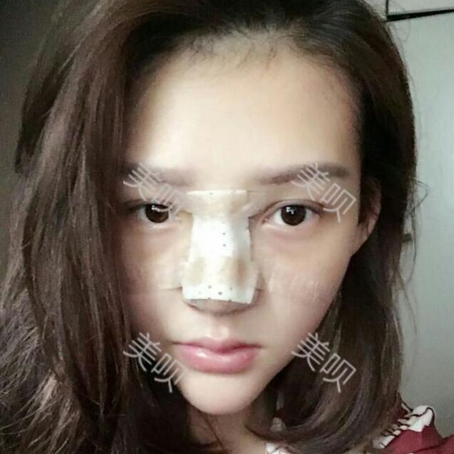 水滴鼻好看吗?我想去做个水滴鼻~~