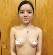 华山连天美程琳傲诺拉水滴型假体隆胸案例分享~ width=