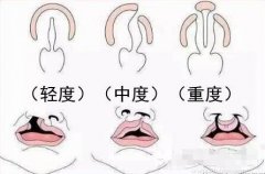 北京调节兔唇的费用大概多少安?贵不贵? width=