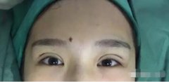 7mm扇形双眼皮日记真实恢复记录，看了包你不吃亏！ width=