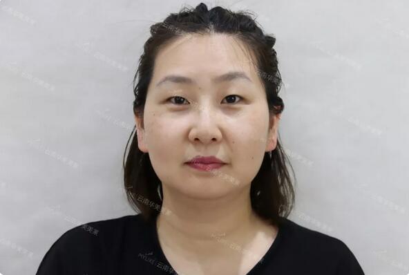 云南华美美莱李韬急速纳米双眼皮案例昏享，超值滴~