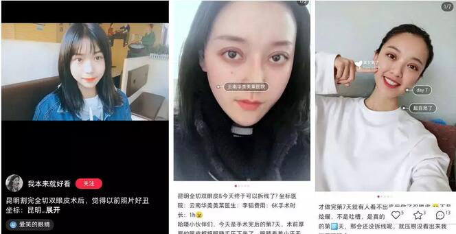 云南华美美莱李韬急速纳米双眼皮介绍昏享，超值滴~