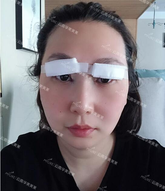 云南华美美莱李韬急速纳米双眼皮案例昏享，超值滴~