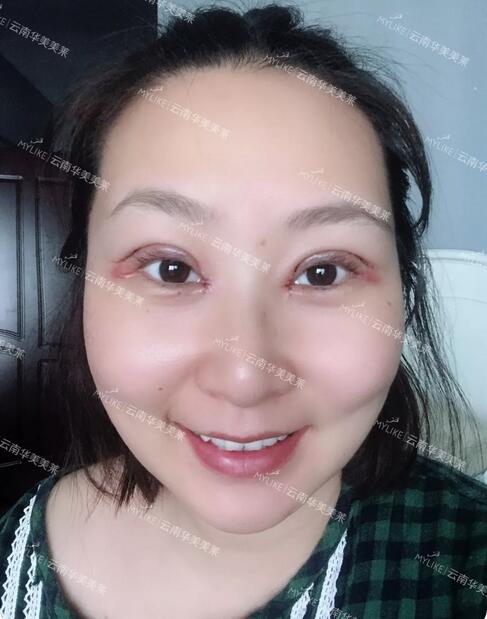 云南华美美莱李韬急速纳米双眼皮案例昏享，超值滴~