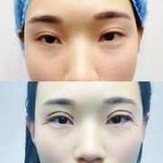 徐丹医生的双眼皮技术怎么样?我这眯眯眼还能改变吗? width=