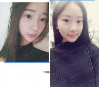 成都铜雀台割双眼皮怎么样？先来看看杨建医生的案例吧！ width=
